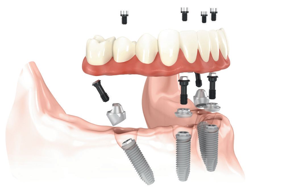diagram of how all-on-4 dental implants work