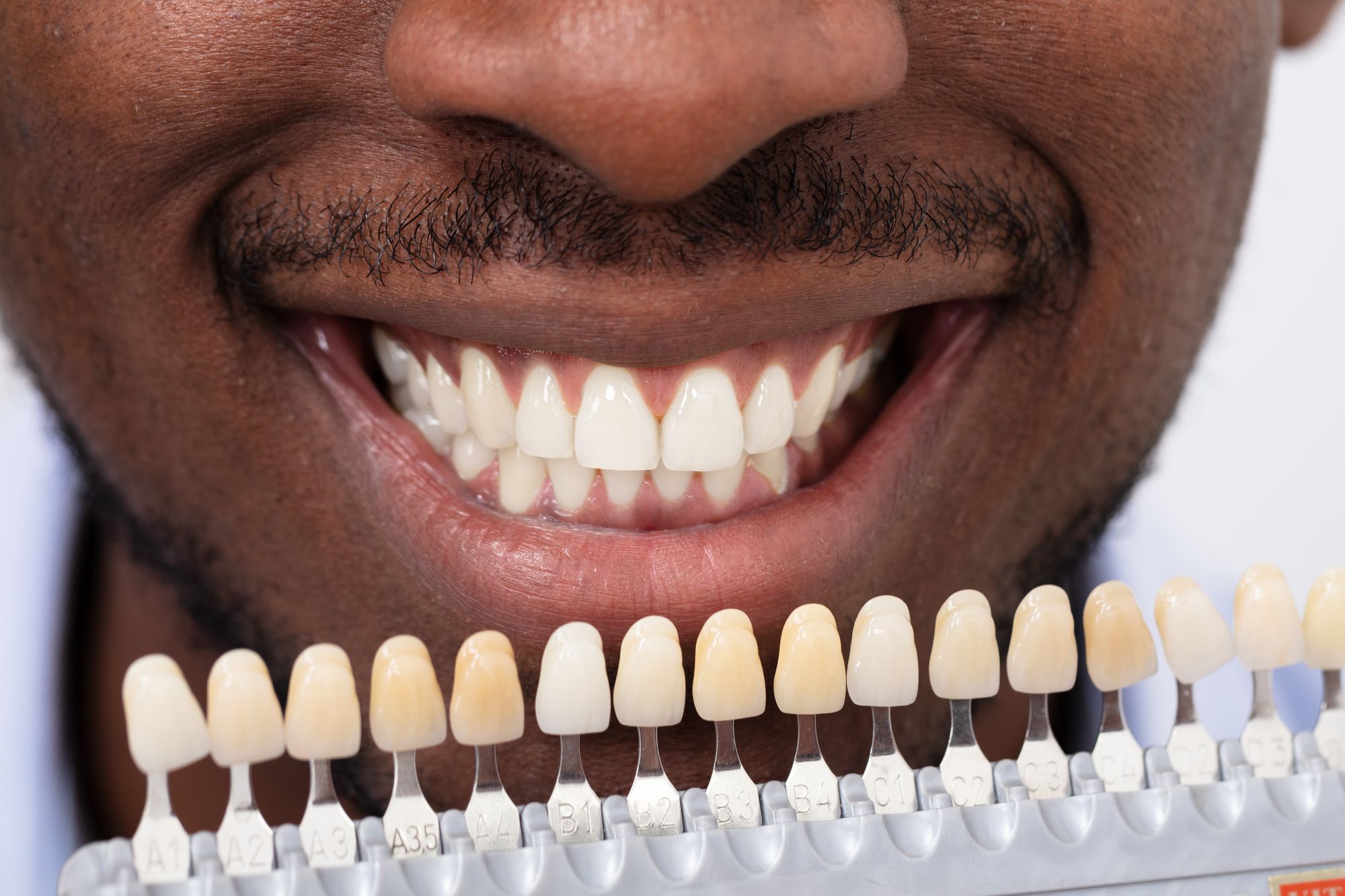 man choosing which shade of dental veneers he wants