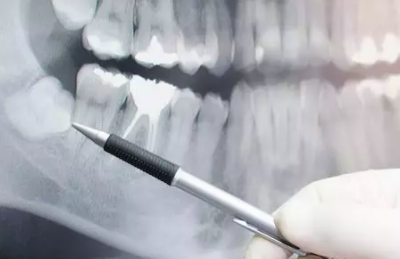 dentist explaining how wisdom teeth removal works using an x-ray