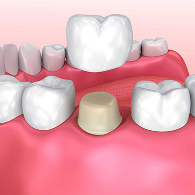 illustration of how a dental crown works